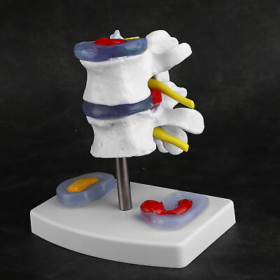 #ad Anatomical Lumbar Disc Herniation Model Human Spine School Training Supplies